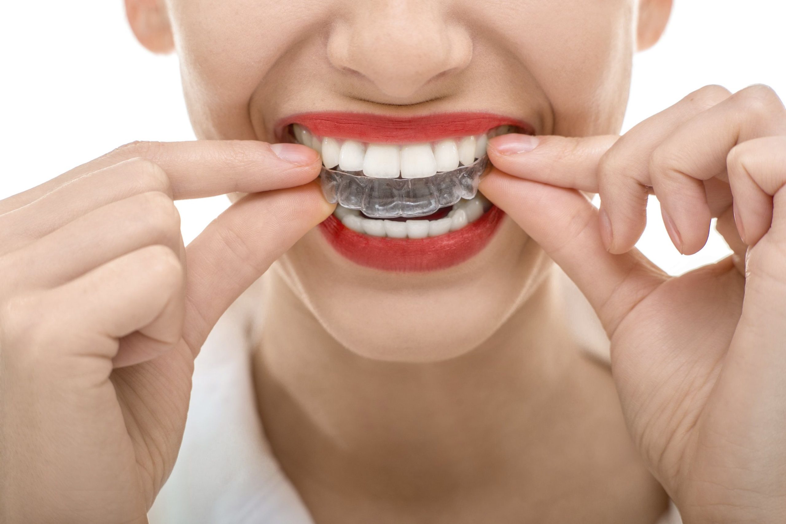 Invisible Innovation: How Invisalign is Shaping the Future of Orthodontic Aesthetics